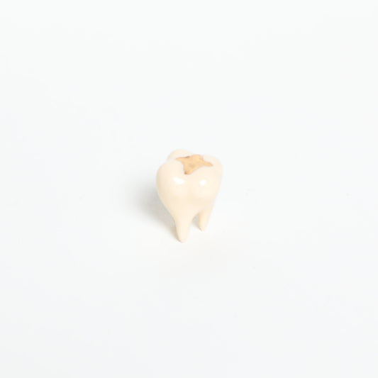 Magic Molar in Gold Filling